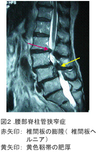 図2.腰部脊柱管狭窄症