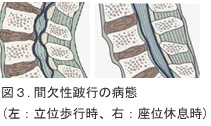 図3.間欠性跛行の病態