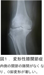 図1.変形性膝関節症
