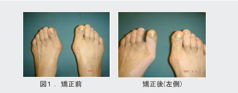 矯正前後